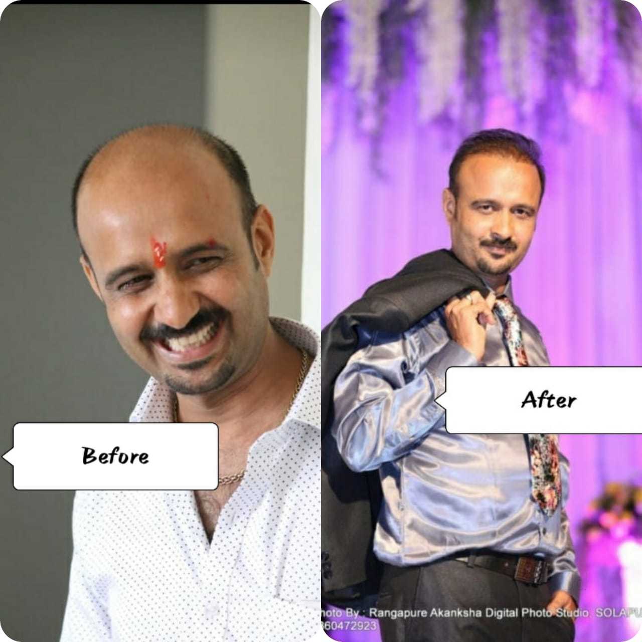 Hair Transplantation