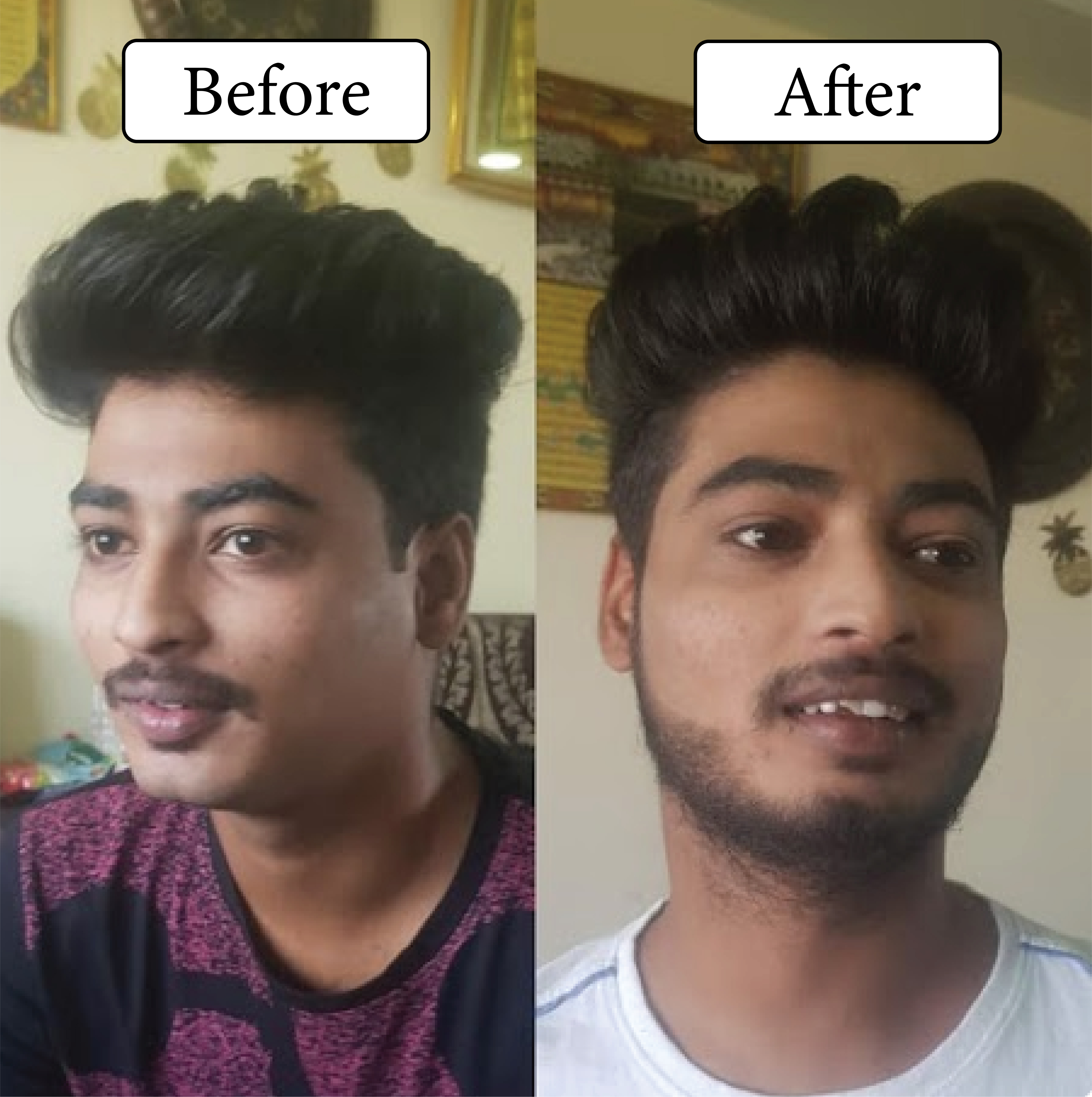 beard Transplant