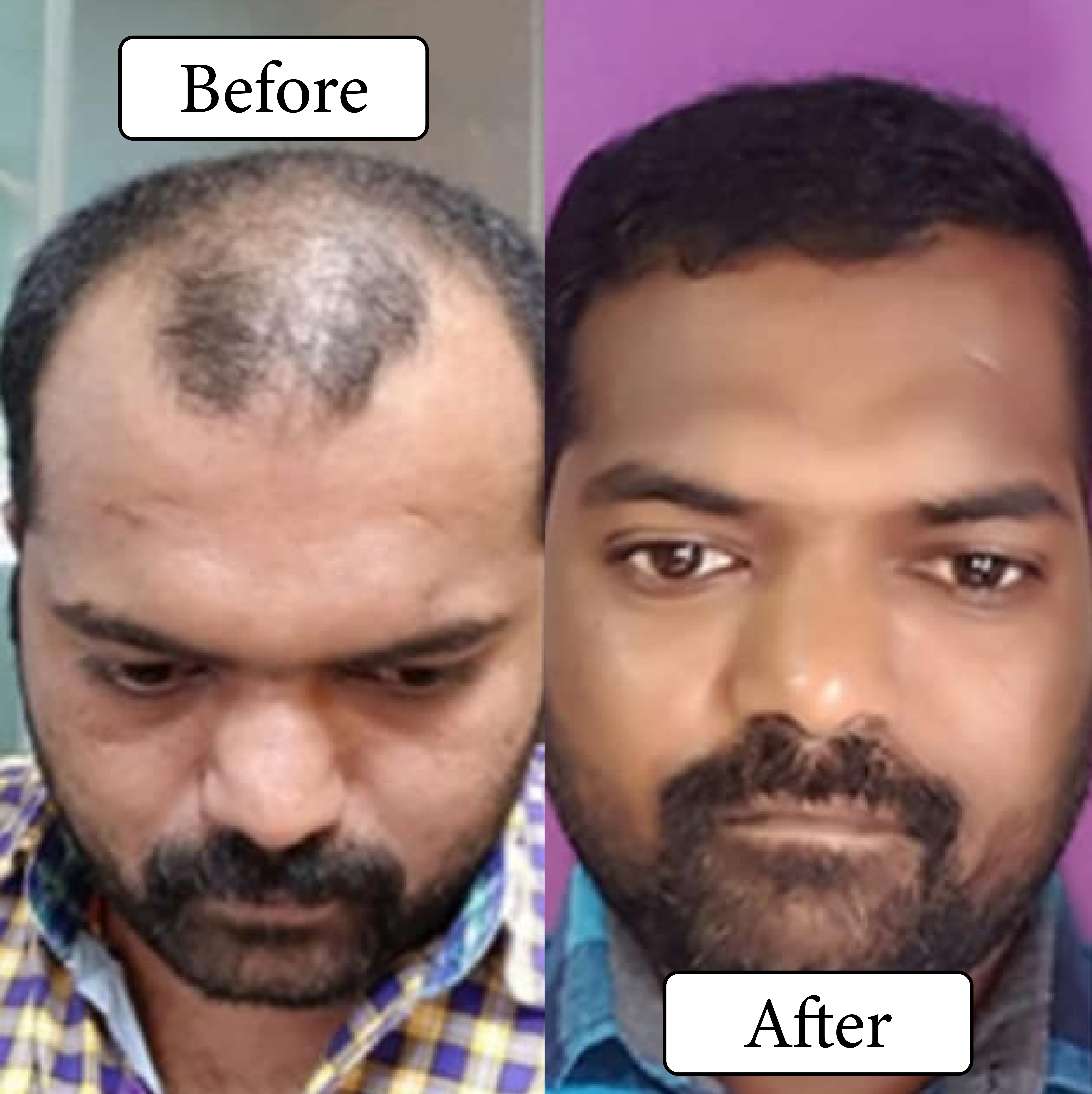 Best hair transplant in India